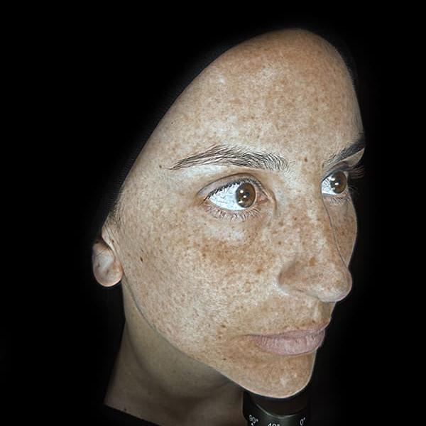 Gallery-Side-Pigmentation-02.jpeg
